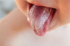 [Translate to Swiss:] Tongue of a toddler with white plaque